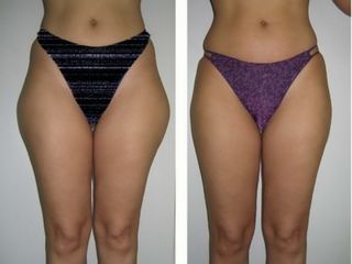Antes y después Intralipoterapia
