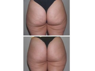 Antes y después Mesoterapia