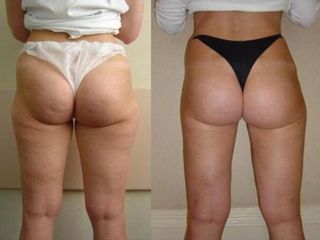 Antes y después Intralipoterapia