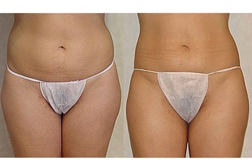Hidrolipoclasia antes y después - 499952