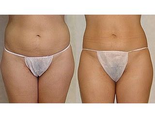 Antes y después Intralipoterapia