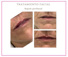 Rellenos faciales - Dra. Alejandra Almenares