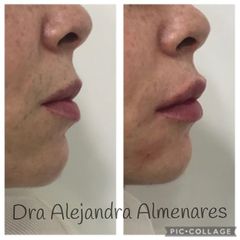 Aumento de labios - Dra. Alejandra Almenares