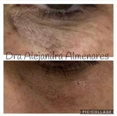 Eliminación de ojeras - Dra. Alejandra Almenares