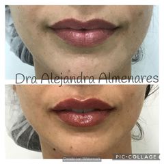 Aumento de labios - Dra. Alejandra Almenares