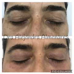 Blefaroplastia sin cirugía - Dra. Alejandra Almenares