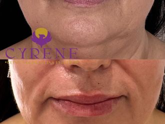 Aumento labios antes y después - 875724