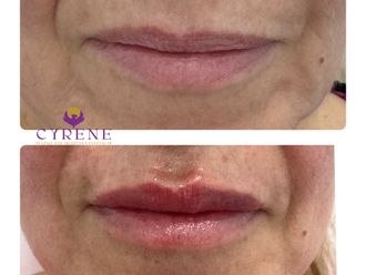 Aumento labios antes y después - 875725