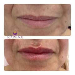 Clínica Cyrene - Armonización labial