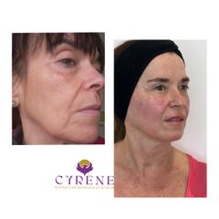 Clínica Cyrene - Bioestimulaciòn de colágeno
