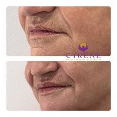 Clínica Cyrene -Armonización labial