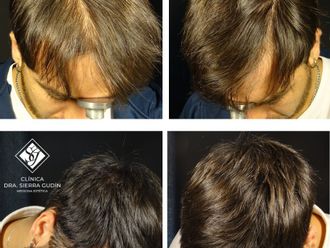 Alopecia antes y después - 878283