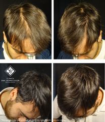 Alopecia androgenética