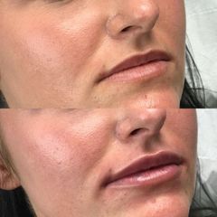 Aumento de labios - Matuca Lips Dra. Cerviño