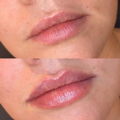 Aumento de labios - Matuca Lips Dra. Cerviño