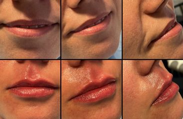 Aumento de labios - Matuca Lips Dra. Cerviño