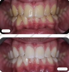 Blanqueamiento dental - Matuca Lips Dra. Cerviño