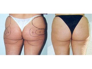 Antes y después liposucción