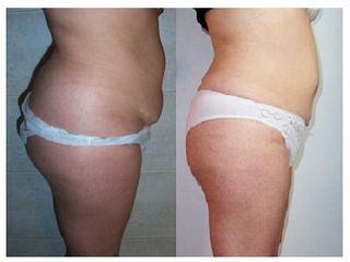 Antes y después liposucción