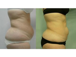 Antes y después liposucción