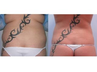 Antes y después liposucción
