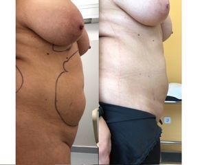 Lipoescultura