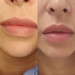 Aumento de labios - Doctor Esquide