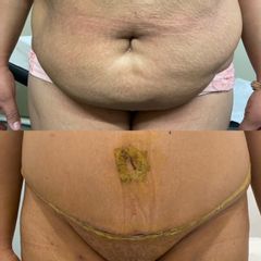 Abdominoplastia - Doctor Esquide