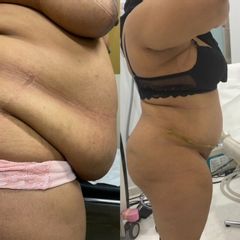 Abdominoplastia - Doctor Esquide