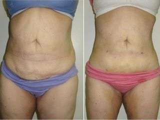 Antes y después Lipoláser abdomen