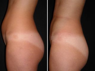Antes y después Lipoláser abdomen