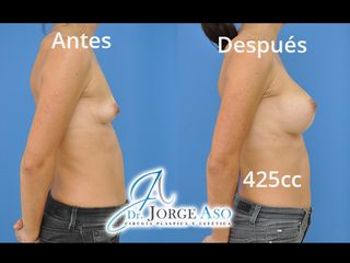 Antes y después Aumento de pecho con implantes de gota de 425 gramos