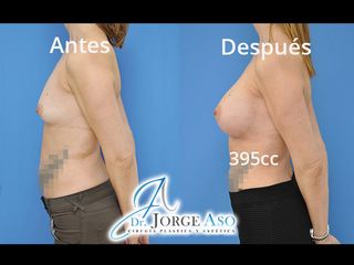 Antes y después Aumento de pecho con implantes anatómicos de 395 cc