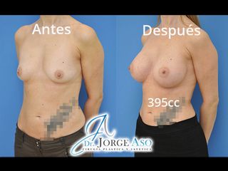 Antes y después Aumento de pecho con implantes anatómicos de 395 cc