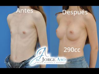 Antes y después Aumento de pecho