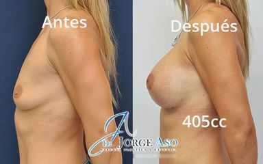 Aumento de pecho - Dr. Jorge Aso