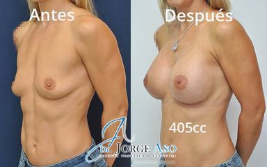 Aumento de pecho - Dr. Jorge Aso
