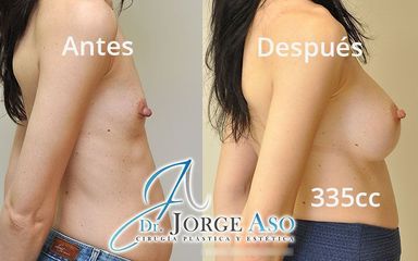 Aumento de pecho - Dr. Jorge Aso