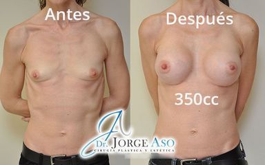 Aumento de pecho - Dr. Jorge Aso