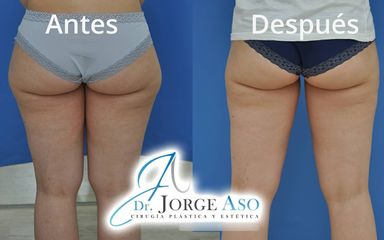 Liposucción - Dr. Jorge Aso