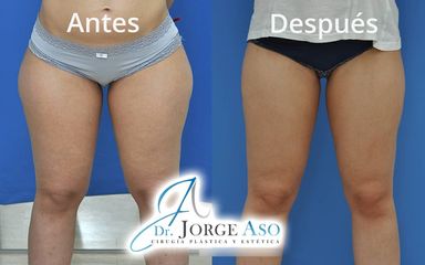 Liposucción - Dr. Jorge Aso