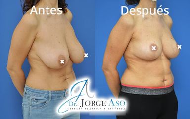 Reducción de senos - Dr. Jorge Aso