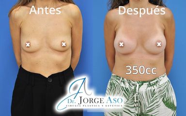 Aumento de pecho - Dr. Jorge Aso