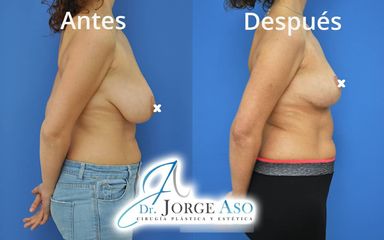 Reducción de senos - Dr. Jorge Aso