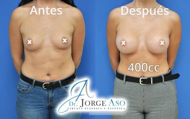 Aumento de pecho - Dr. Jorge Aso