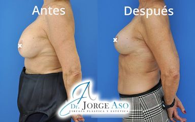 Mastopexia - Dr. Jorge Aso
