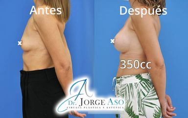 Aumento de pecho - Dr. Jorge Aso