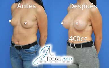 Aumento de pecho - Dr. Jorge Aso