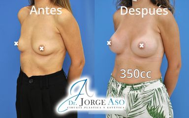 Aumento de pecho - Dr. Jorge Aso