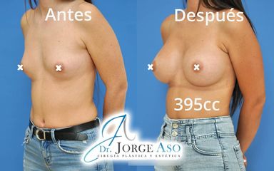 Aumento de pecho - Dr. Jorge Aso